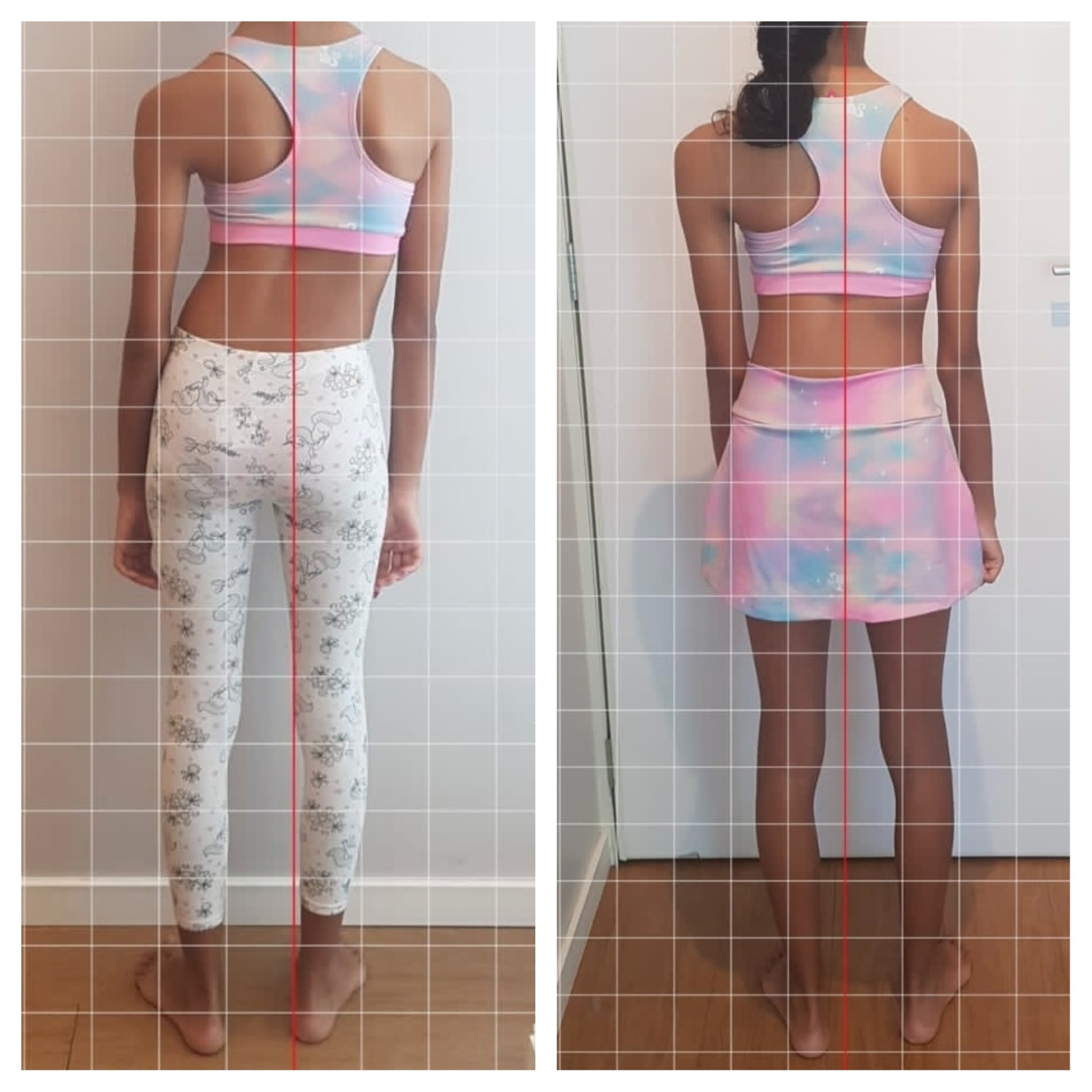 Antes e depois da avaliação postural de uma paciente adolescente
