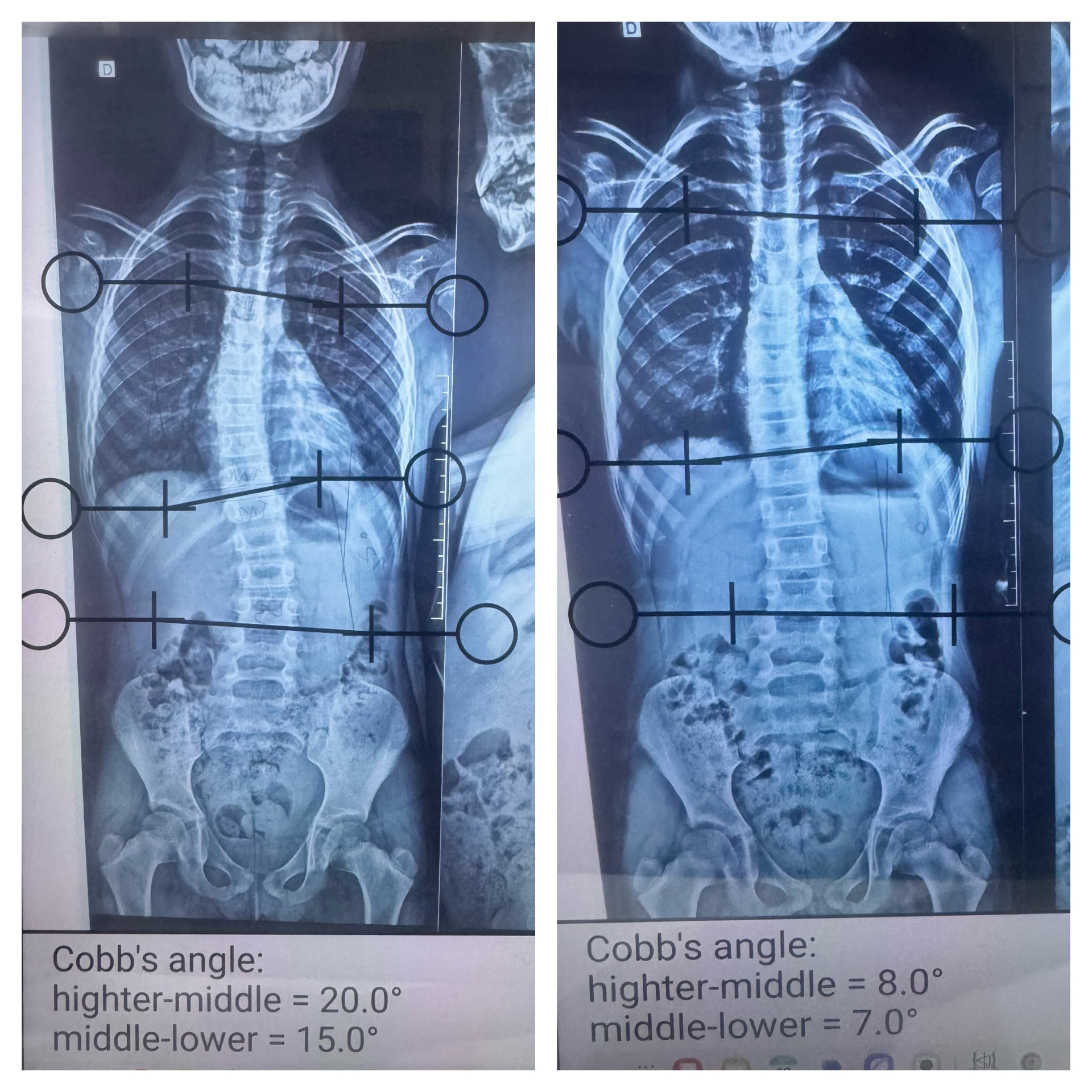 Radiografias antes e depois do tratamento, com ângulo de Cobb reduzido de 20° e 15° para 8° e 7°