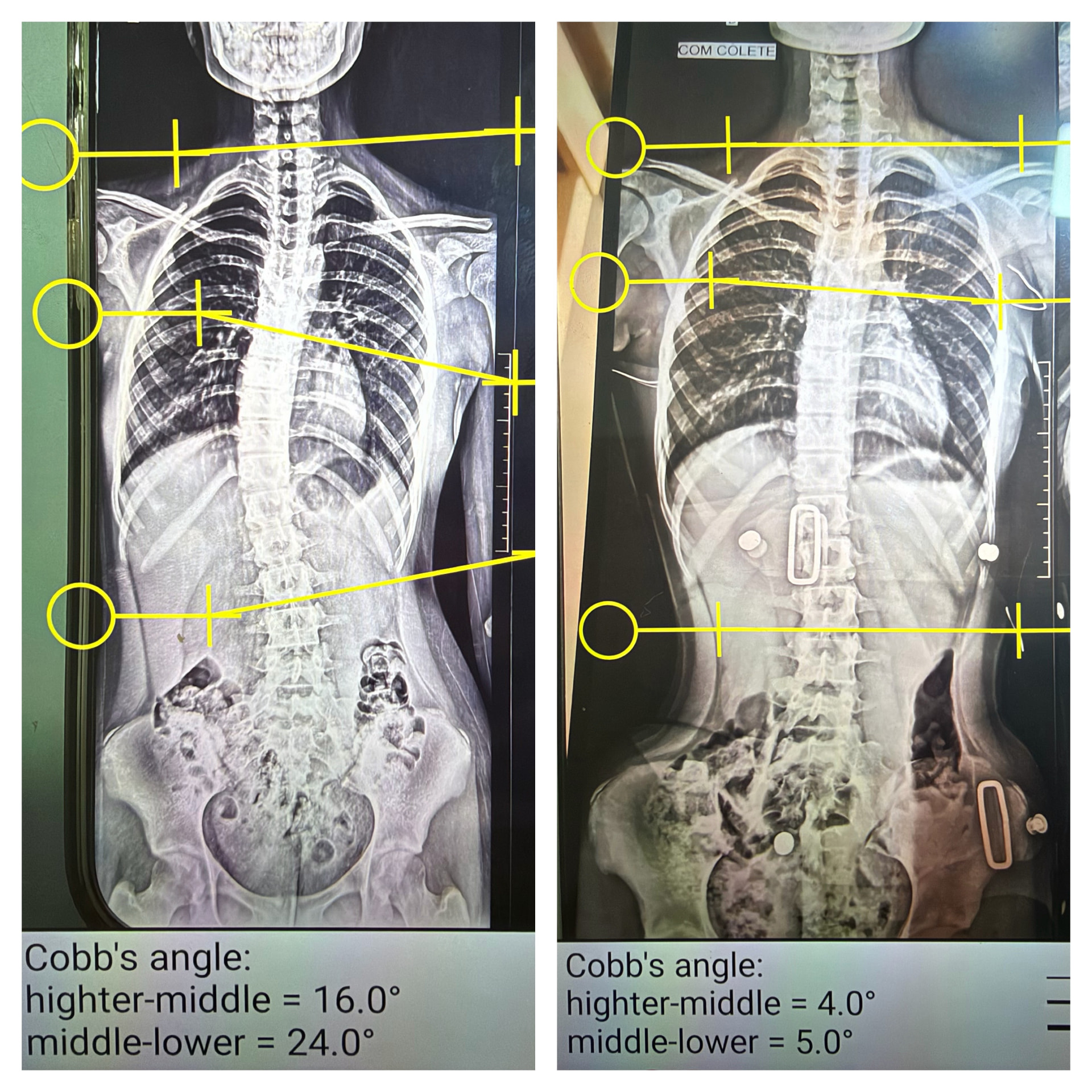 Radiografias sem e com colete, com ângulo de Cobb reduzido de 16° e 24° para 4° e 5°